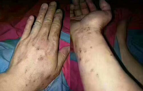 劣质真瓷胶后果 劣质真瓷胶后果